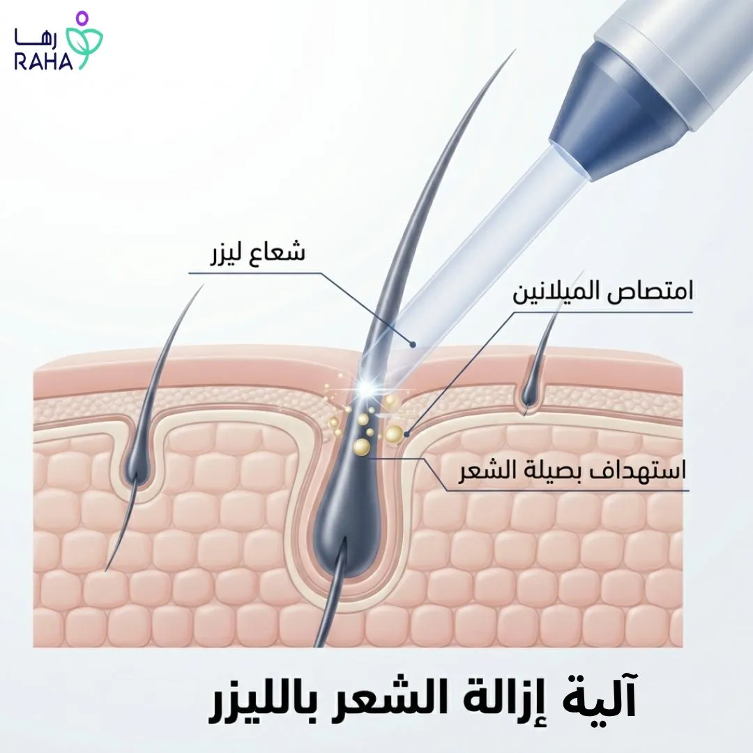 كيف يعمل الليزر على تقليل نمو الشعر؟